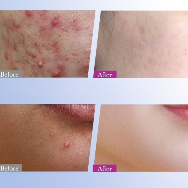 7/10/14 Buah Koyo Jerawat Bint - Skincare Qv ulasan dan harga